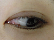 下眼瞼母斑の施術前